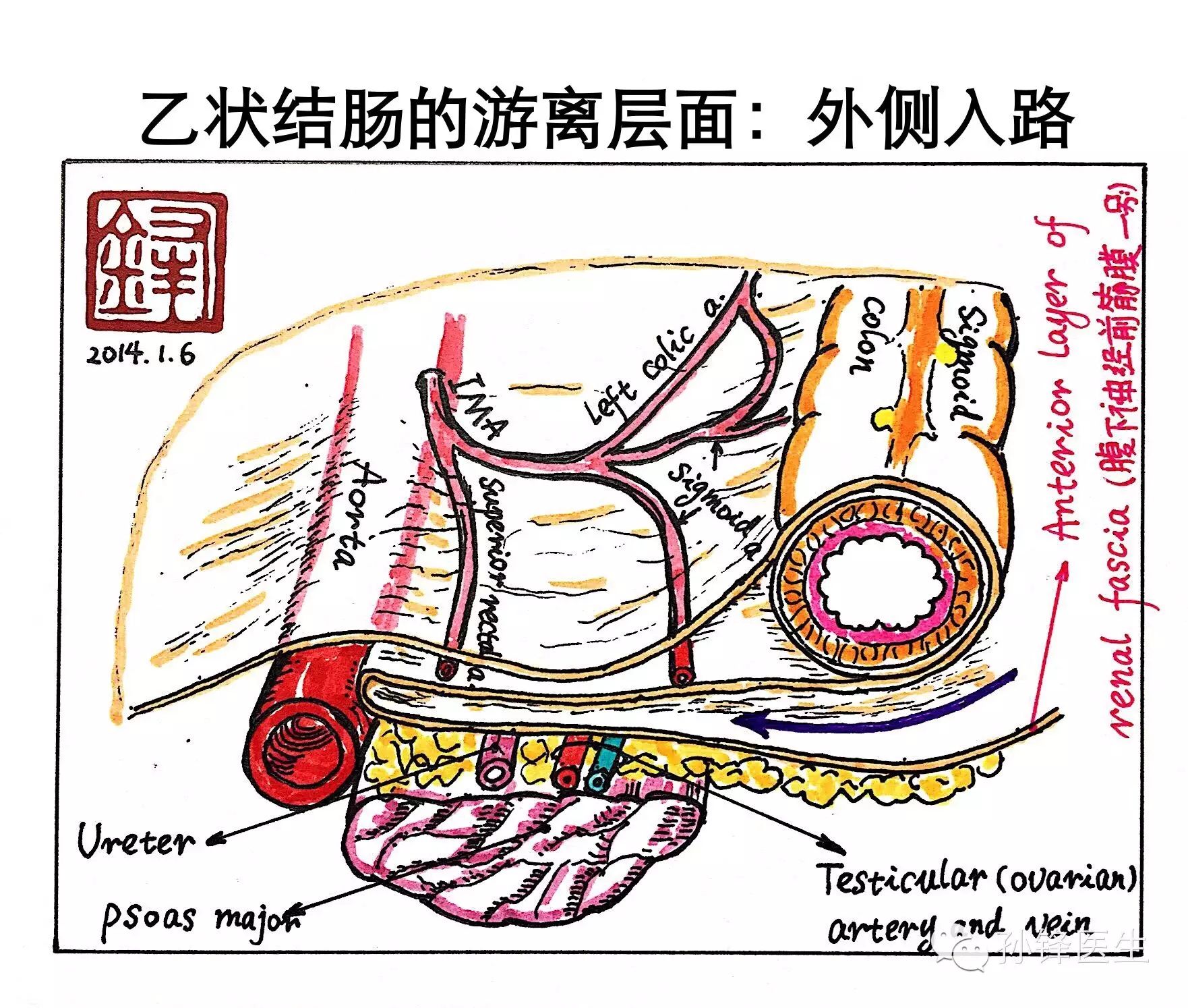 图(2):乙状结肠切除术的筋膜解剖入路