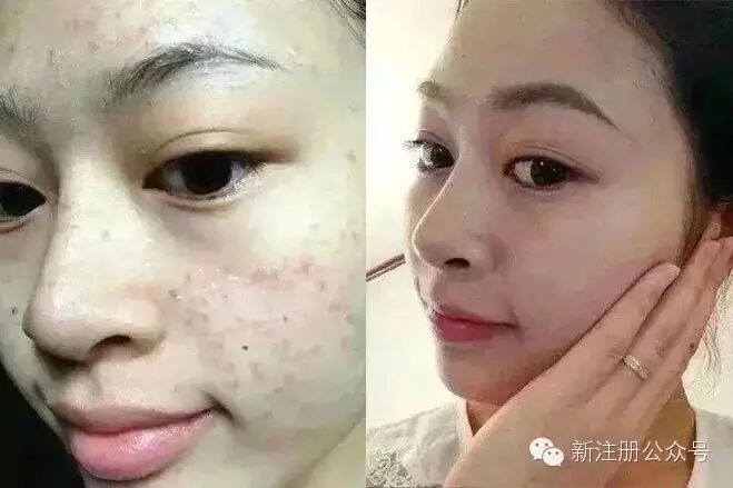 清痘有危害吗 张杰是怎么祛痘的 黄皮肤可以祛痘吗 什么医...