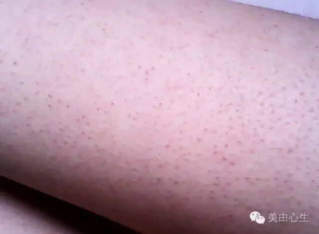 毛周角化症？鸡皮病？毛囊炎？到底是什么？