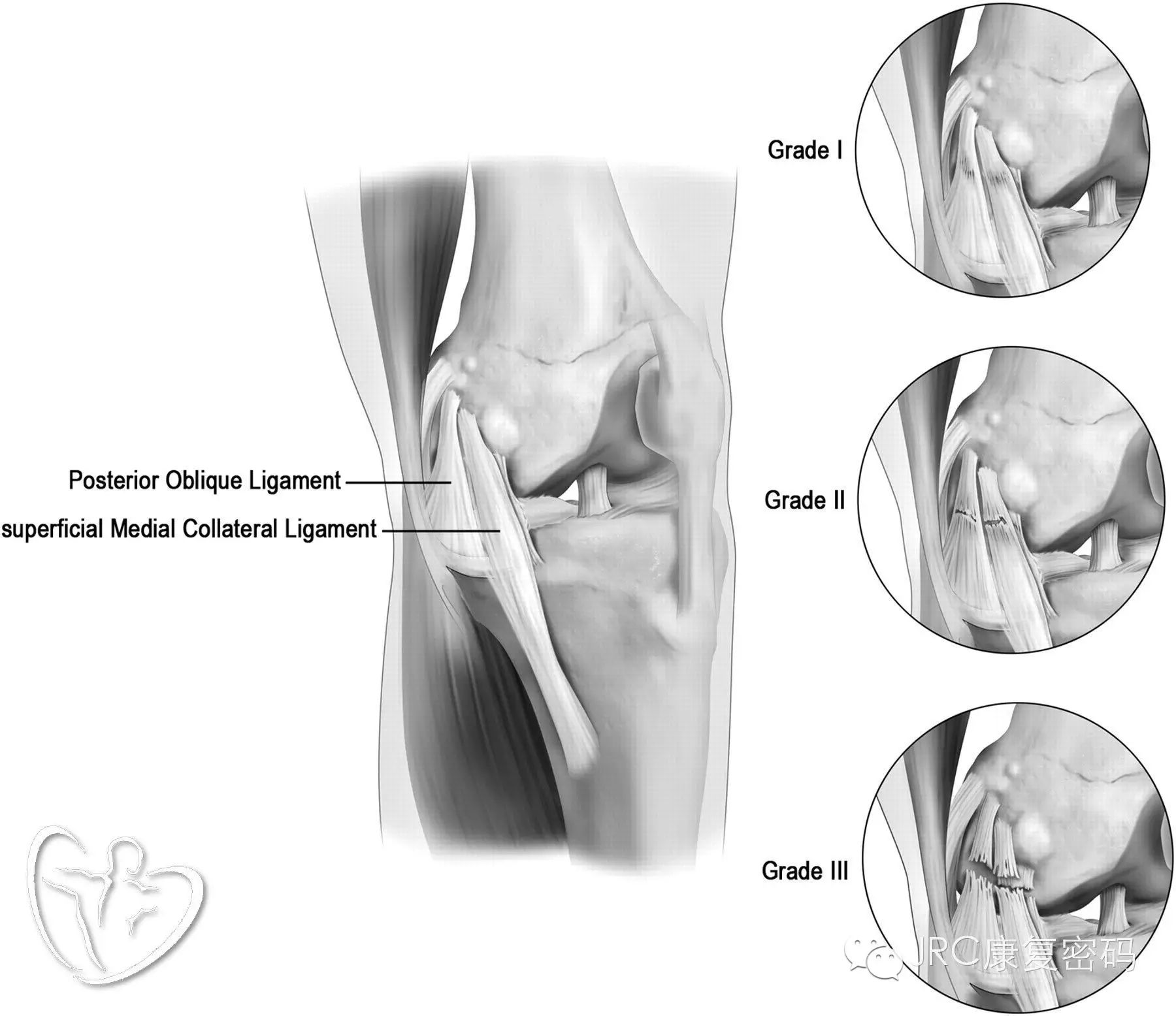 膝关节o′donoghue恐怖三联征的损伤特征与康复训练「jrc康复密码」