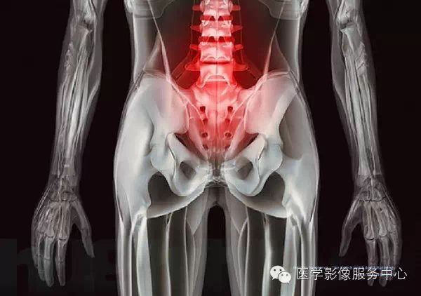 红色部分显示了在我们身体中,背部疼痛向四周辐射的样子.