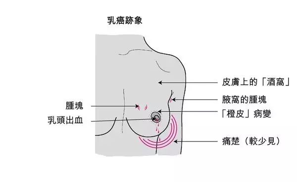 乳房肿块发展到一定程度,将隆起于皮肤表面,或伴有皮肤表面色素沉着.