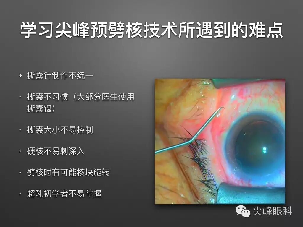 手术镊怎么尖峰眼科 ｜ 撕囊碎核镊尖峰预劈核白内障手术 祁勇军_https://www.jmylbn.com_新闻资讯_第7张