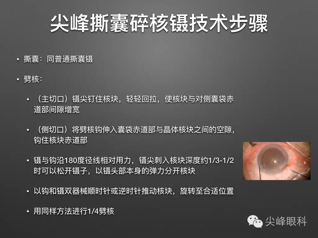 手术镊怎么尖峰眼科 ｜ 撕囊碎核镊尖峰预劈核白内障手术 祁勇军_https://www.jmylbn.com_新闻资讯_第12张