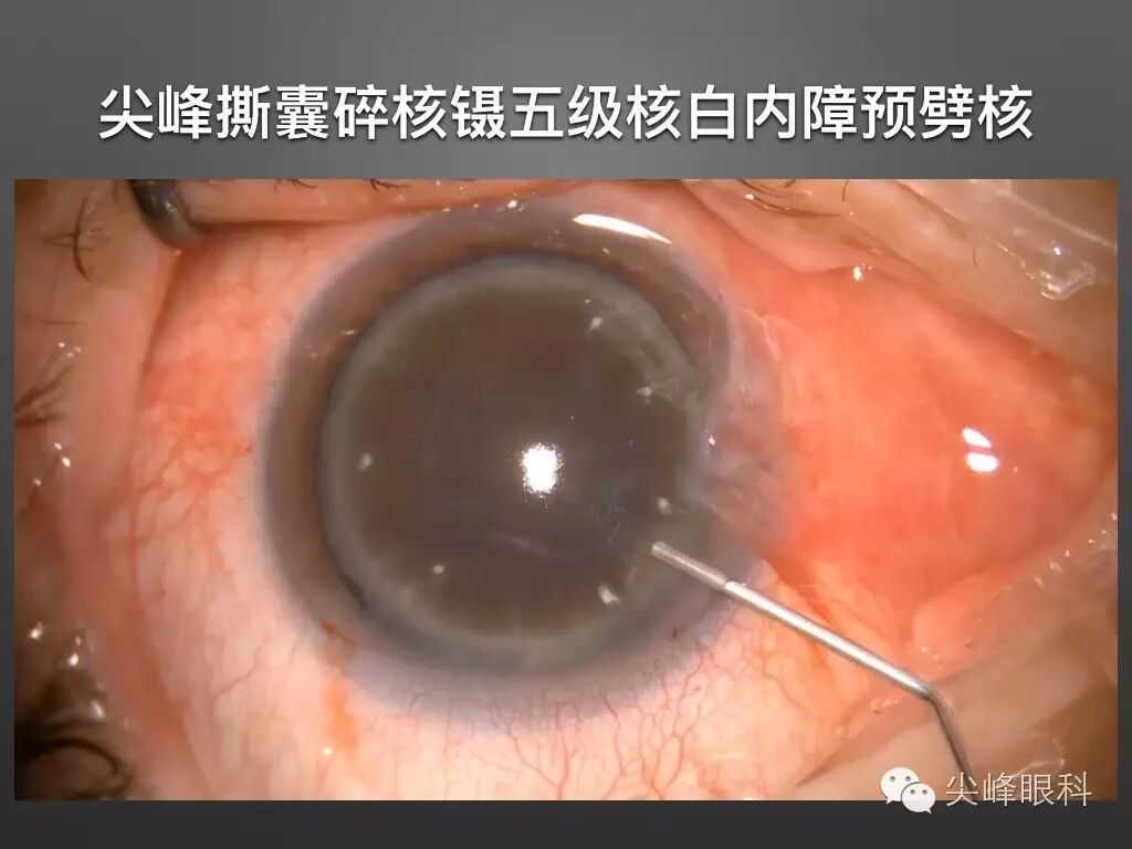 手术镊怎么尖峰眼科 ｜ 撕囊碎核镊尖峰预劈核白内障手术 祁勇军_https://www.jmylbn.com_新闻资讯_第22张