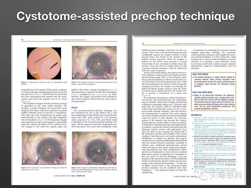 手术镊怎么尖峰眼科 ｜ 撕囊碎核镊尖峰预劈核白内障手术 祁勇军_https://www.jmylbn.com_新闻资讯_第6张