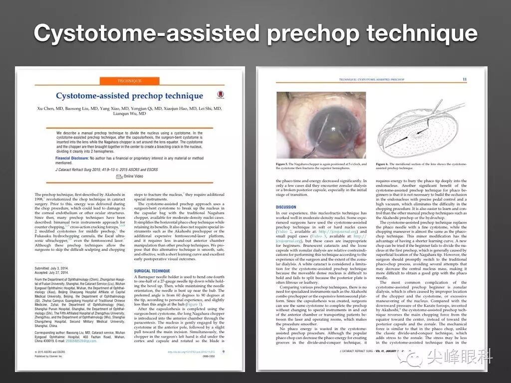 手术镊怎么尖峰眼科 ｜ 撕囊碎核镊尖峰预劈核白内障手术 祁勇军_https://www.jmylbn.com_新闻资讯_第5张