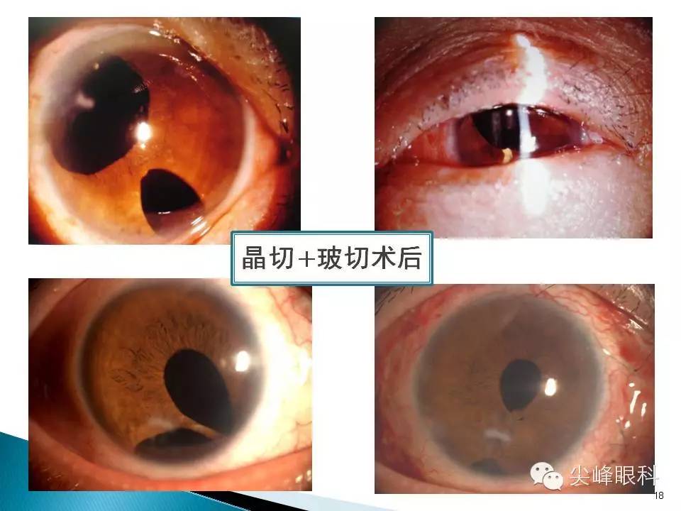 在此有问题请问角膜病专家 白内障术后瞳孔上移最多见,主要是白内障术