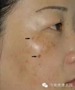 【喜上加喜】二孩政策放开了,二胎之后肚皮上的这些问题,也都不是问题!-怀孕期