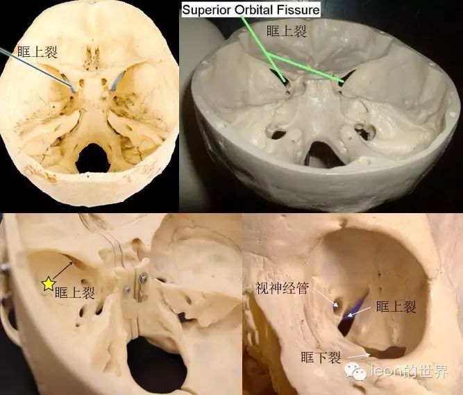 在眶上壁与眶外壁的交界处,由蝶骨大小翼组成这里来个番外:眶上裂在哪