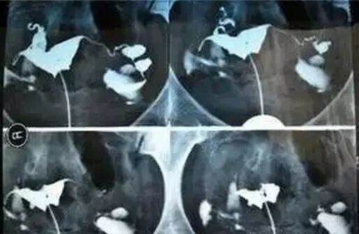 【东方不孕专家解析】:不孕“瞄上”二胎妈 中年夫妻备孕到底有多难?-怀孕期