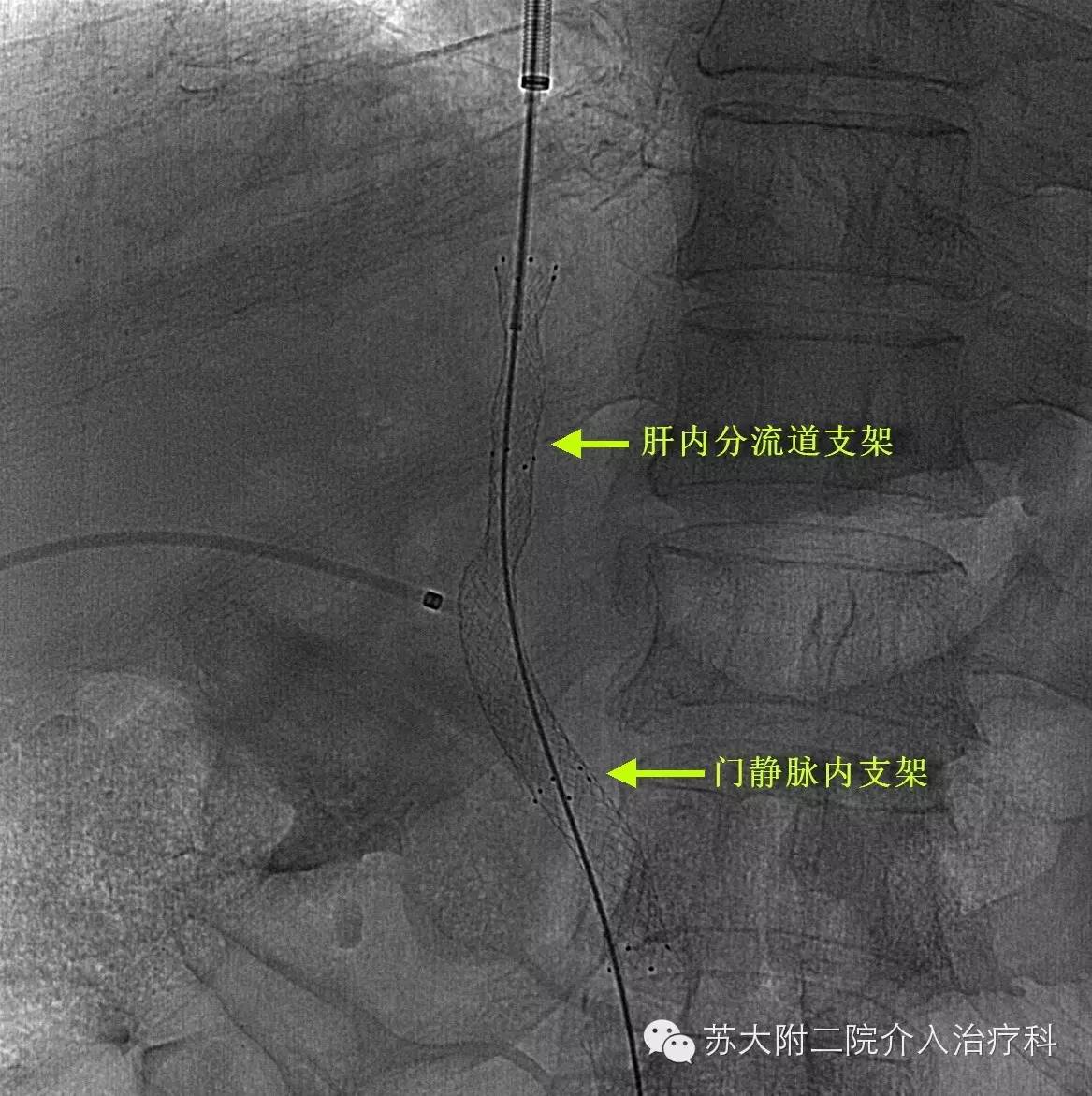 tips手术成功治愈门静脉及肠系膜静脉全程血栓患者