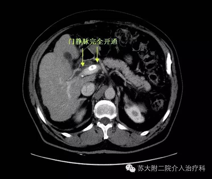 图示:增强ct术后6天复查,肝内外门静脉完全恢复正常血流充盈