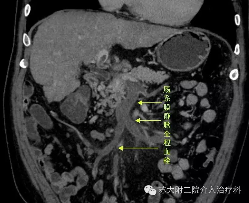 tips手术成功治愈门静脉及肠系膜静脉全程血栓患者