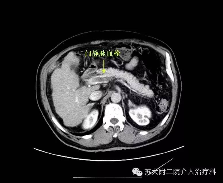 tips手术成功治愈门静脉及肠系膜静脉全程血栓患者