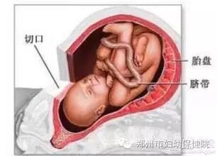 “勇敢”妈妈剖宫产3个月又怀孕 幸遇妙手转危为安-怀孕期
