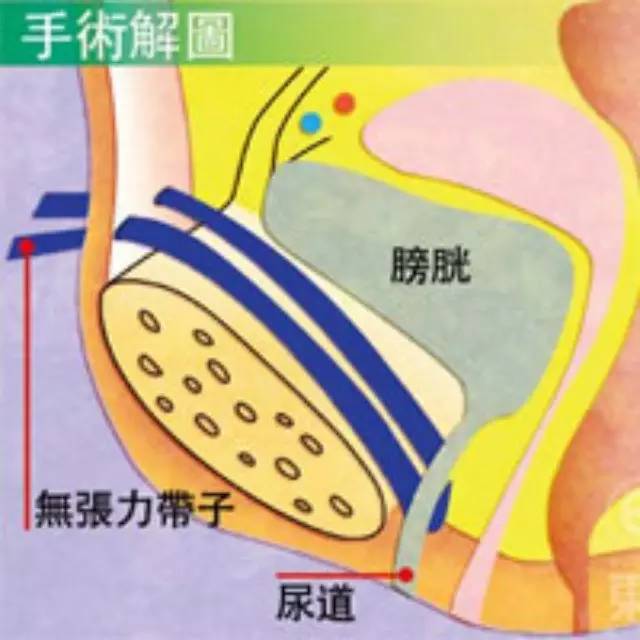 83,两组比较,差异蜹vt 无张力性尿道中段悬吊术 手术治疗女性压力性