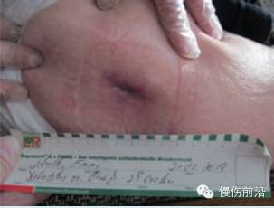 抗菌清创敷料有什么用PHMB在伤口感染治疗中的应用_https://www.jmylbn.com_新闻资讯_第9张