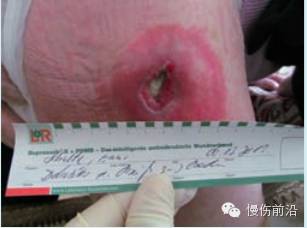 抗菌清创敷料有什么用PHMB在伤口感染治疗中的应用_https://www.jmylbn.com_新闻资讯_第8张