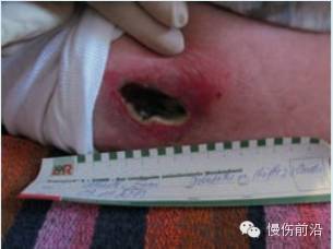 抗菌清创敷料有什么用PHMB在伤口感染治疗中的应用_https://www.jmylbn.com_新闻资讯_第7张