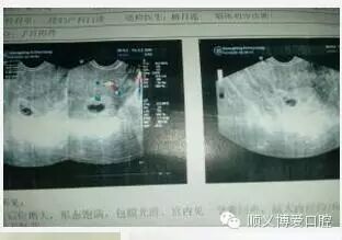 怀孕4个月的肚子如同8个月大,来医院一查惊呆了~~-怀孕期