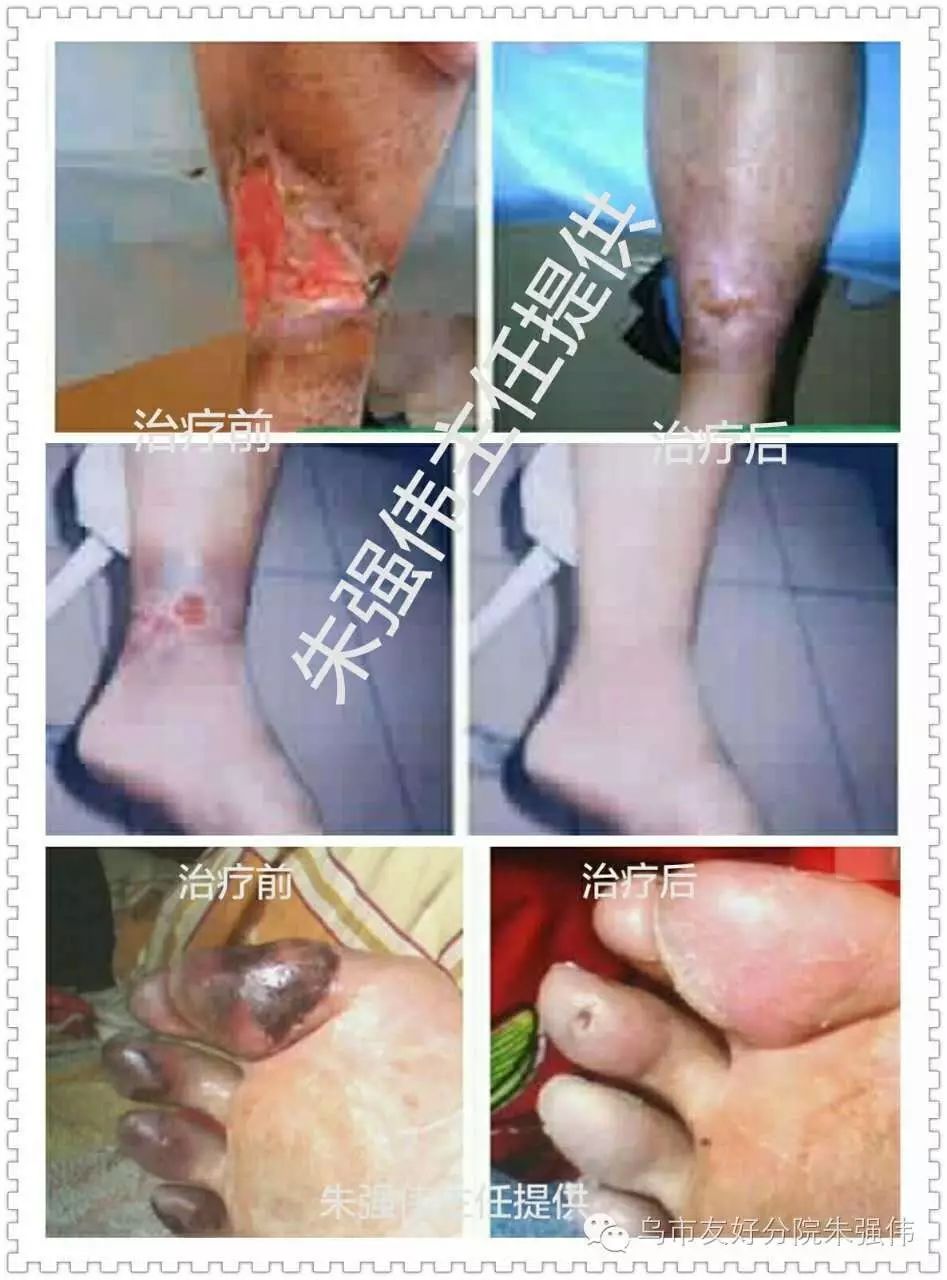静脉炎;脉管炎;淋巴管炎;闭塞性动脉硬
