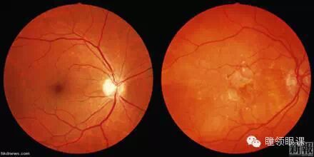 什么是对比敏感度【瞳领眼科知识】对比敏感度视力测量的临床意义_https://www.jmylbn.com_新闻资讯_第6张