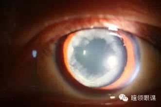 什么是对比敏感度【瞳领眼科知识】对比敏感度视力测量的临床意义_https://www.jmylbn.com_新闻资讯_第5张