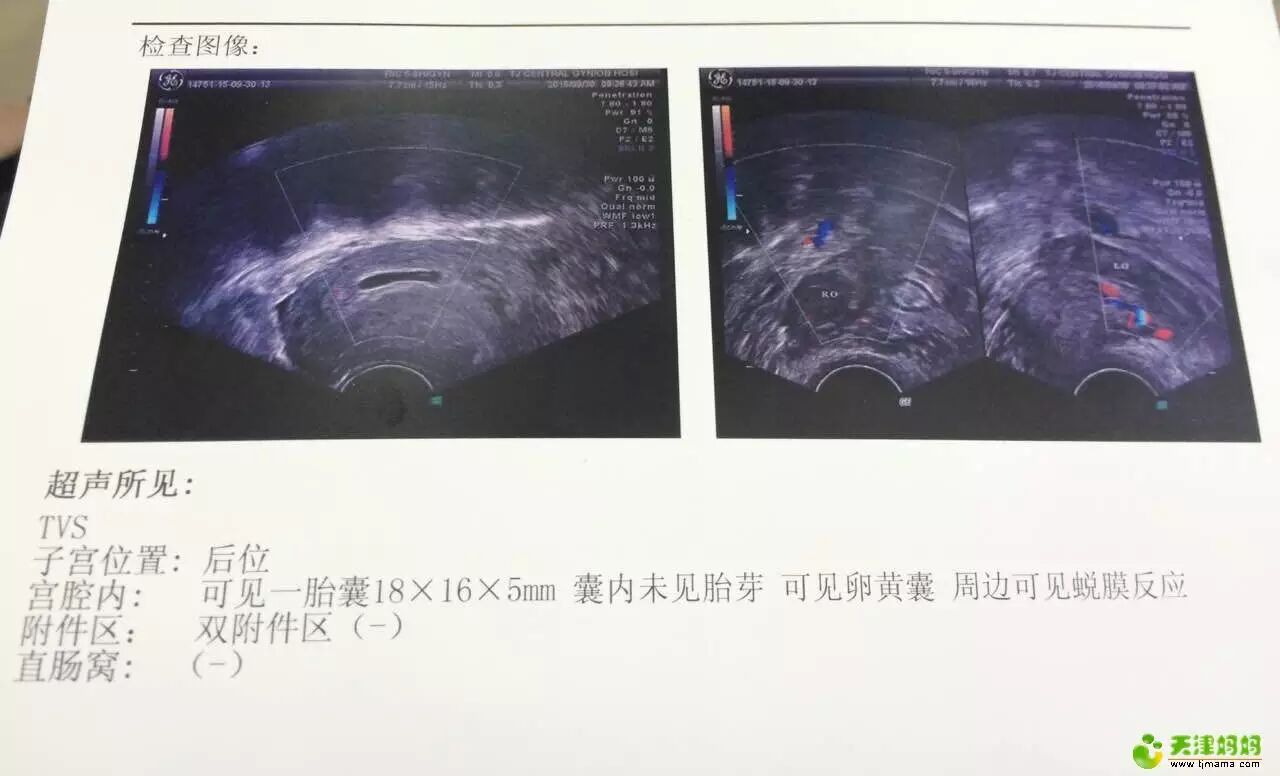 怀孕日记嘟嘟宝贝驾到与不可忽视的先兆流产~