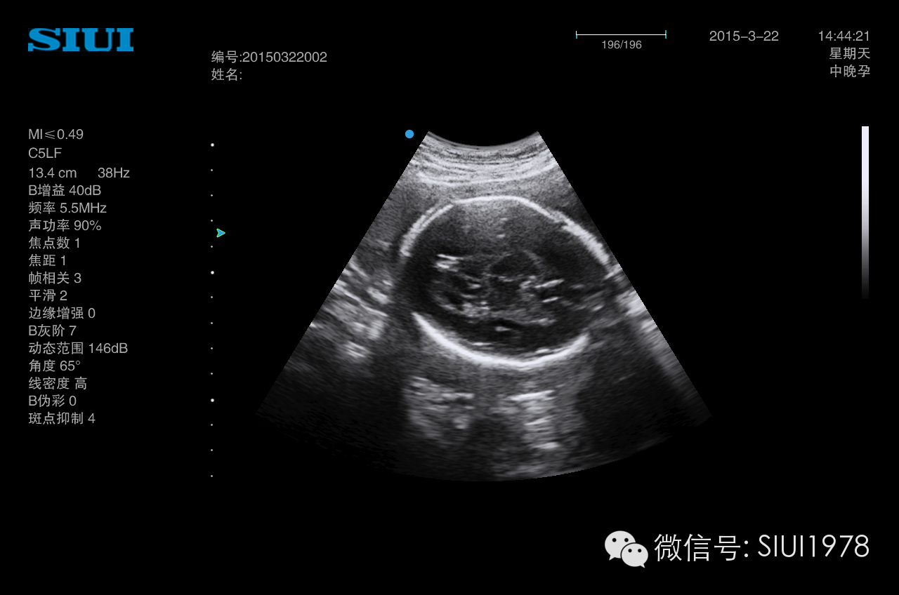 胎儿系统超声检查切面及临床意义(一)