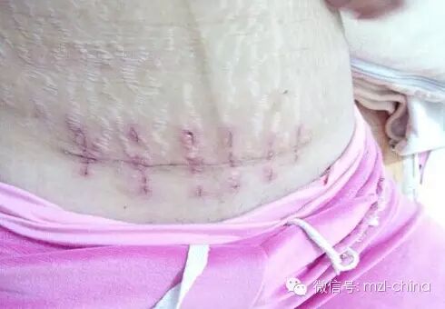 剖宫产后生二胎怀孕4月子宫竟破裂,警惕!盆腔修复刻不容缓!-怀孕期