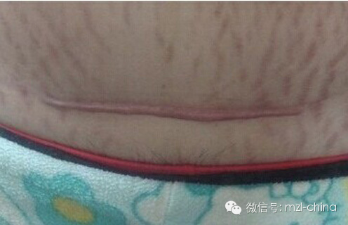 剖宫产后生二胎怀孕4月子宫竟破裂,警惕!盆腔修复刻不容缓!-怀孕期