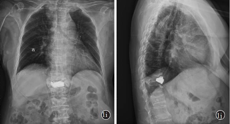 术后3 年胸椎正侧位x 线片示骨水泥向前移位加重