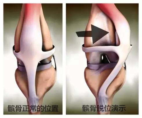 健朗医疗教您认识一种膝关节疼，叫髌骨软化！(图8)