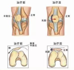健朗医疗教您认识一种膝关节疼，叫髌骨软化！(图15)