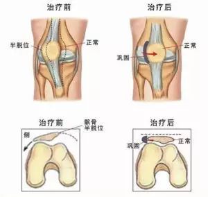 健朗医疗教您认识一种膝关节疼，叫髌骨软化！(图15)