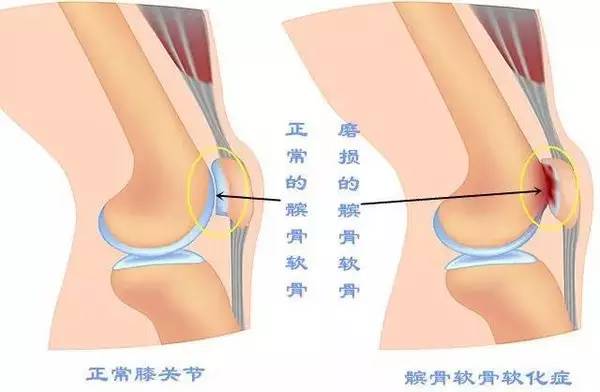 健朗医疗教您认识一种膝关节疼，叫髌骨软化！(图3)