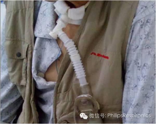 epap什么模式无创呼吸机（二）_https://www.jmylbn.com_新闻资讯_第27张