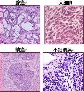 随着技术进步,医生发现可以根据临床特征,尤其是显微镜下癌细胞的特点