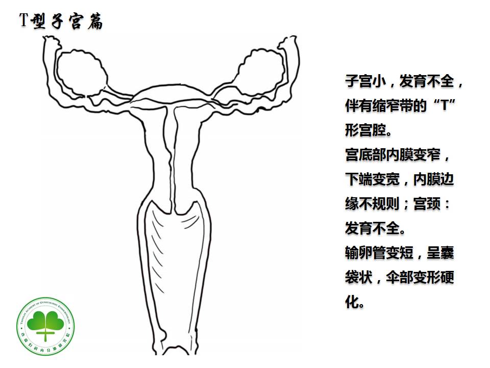 医学漫画:浅谈子宫畸形