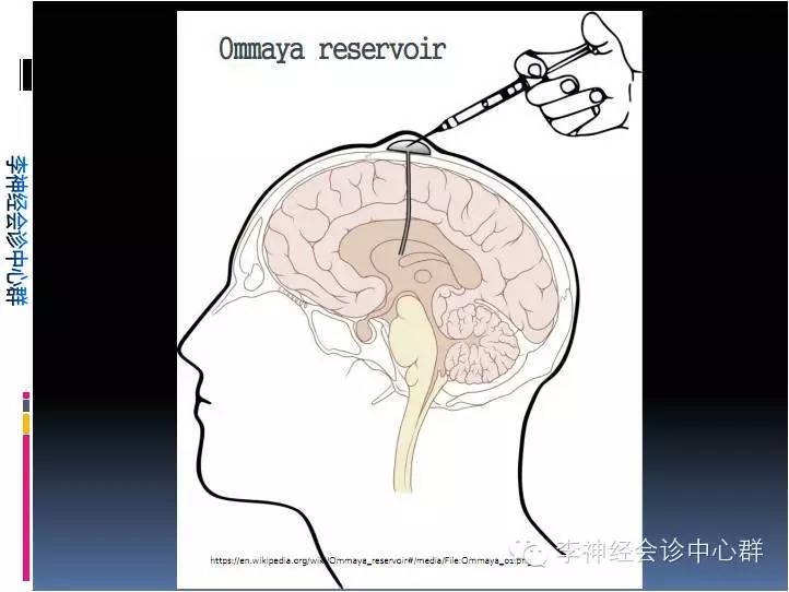 ommaya囊置入术 在神经系统疾病治疗中的应用价值