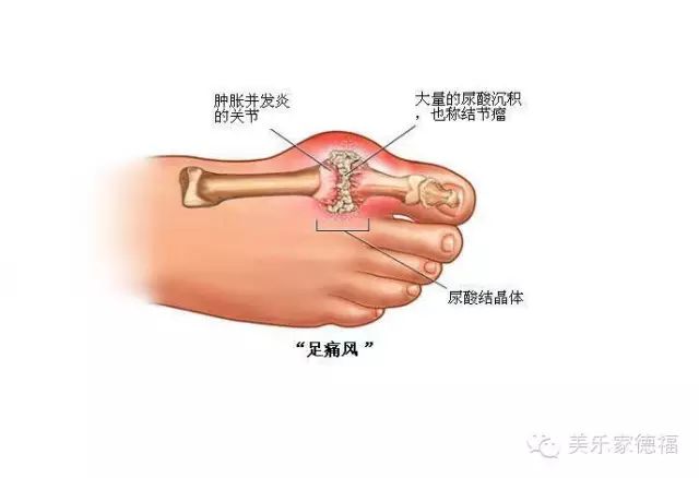 酸毒的结晶体最容易积聚在这里,也有的人是大拇指关节痛,都是同样的