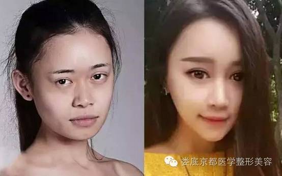 【整成Angelababy】女大学生自爆整形日记!