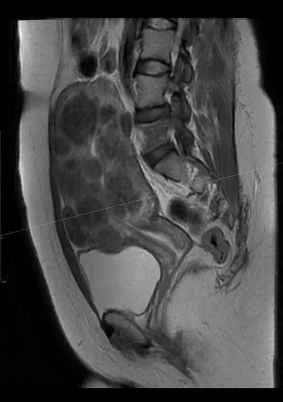 术后怀孕:子宫肌瘤栓塞术优于切除术-怀孕期
