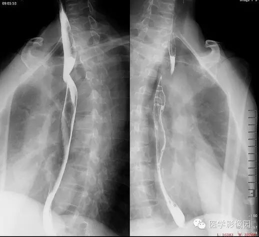 迷走右锁骨下动脉误诊为食管癌5例报道