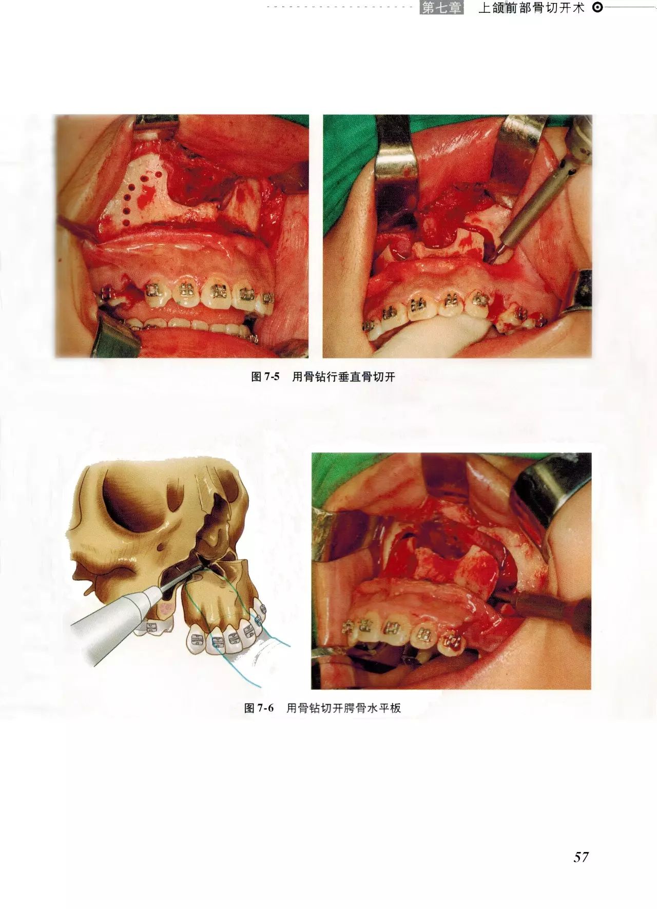 《颌面骨骼整形手术图谱》节选学习(主编:胡静,王大章)