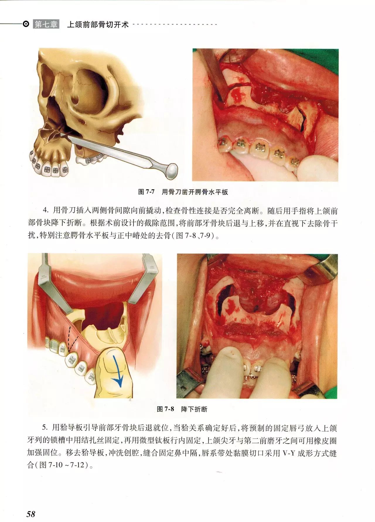 下颌前部根尖下骨切开术 第十二章 颏成形术 第十三章 双颌外科手术