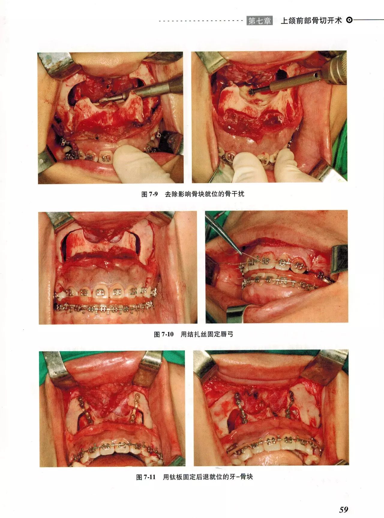 《颌面骨骼整形手术图谱》节选学习(主编:胡静,王大章)