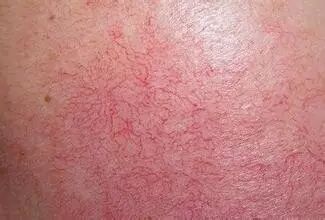 红血丝怎么修复？