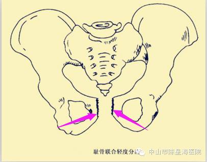 【星医健康】怀孕后为什么“下身”会痛?为您解开孕期“耻骨分离症”之谜-怀孕期